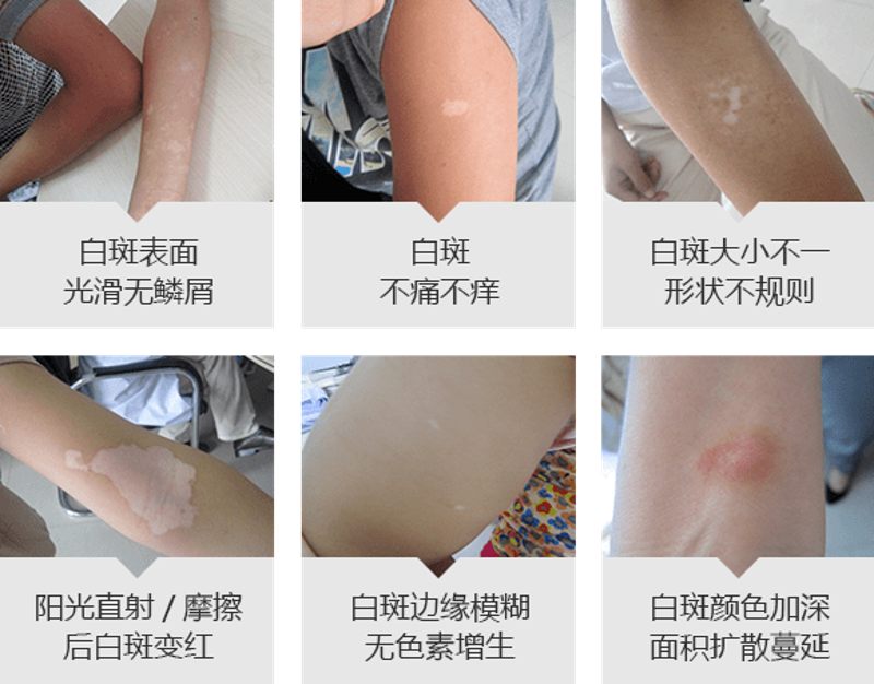 阜阳看白癜风