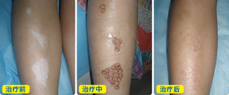 阜阳治疗白癜风医院:探寻最佳治疗方案